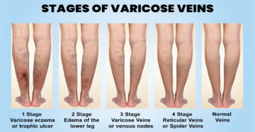 causes of blockage in veins