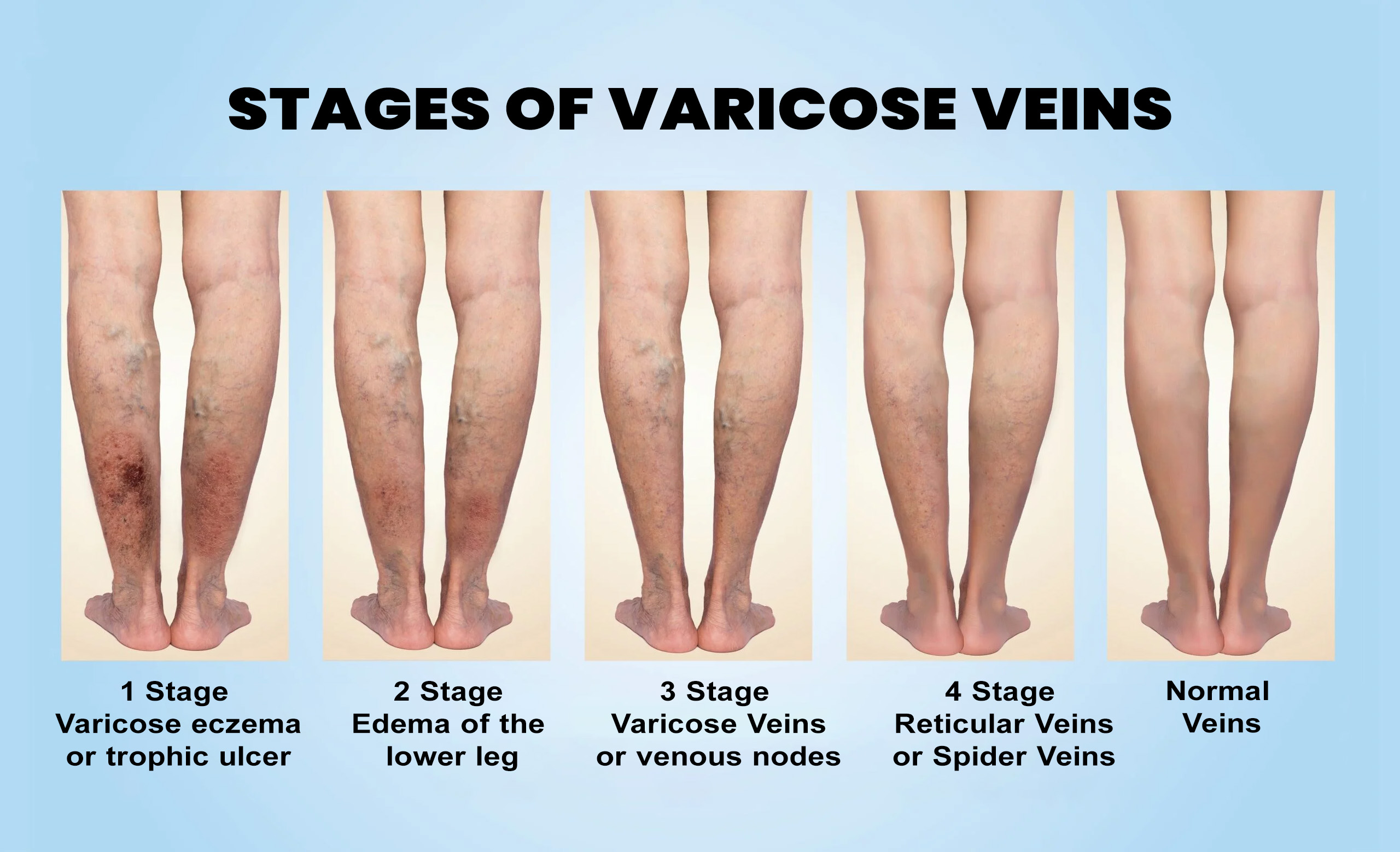 causes of blockage in veins