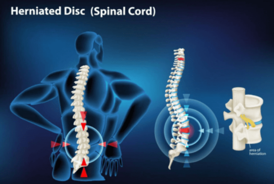 Herniated Disc