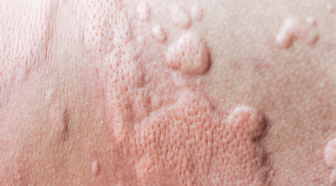 Skin Allergy
