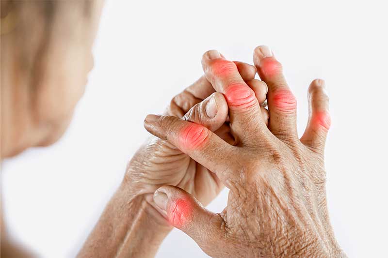 Arthritis: Causes, Symptoms & Effective Ayurvedic Remedy