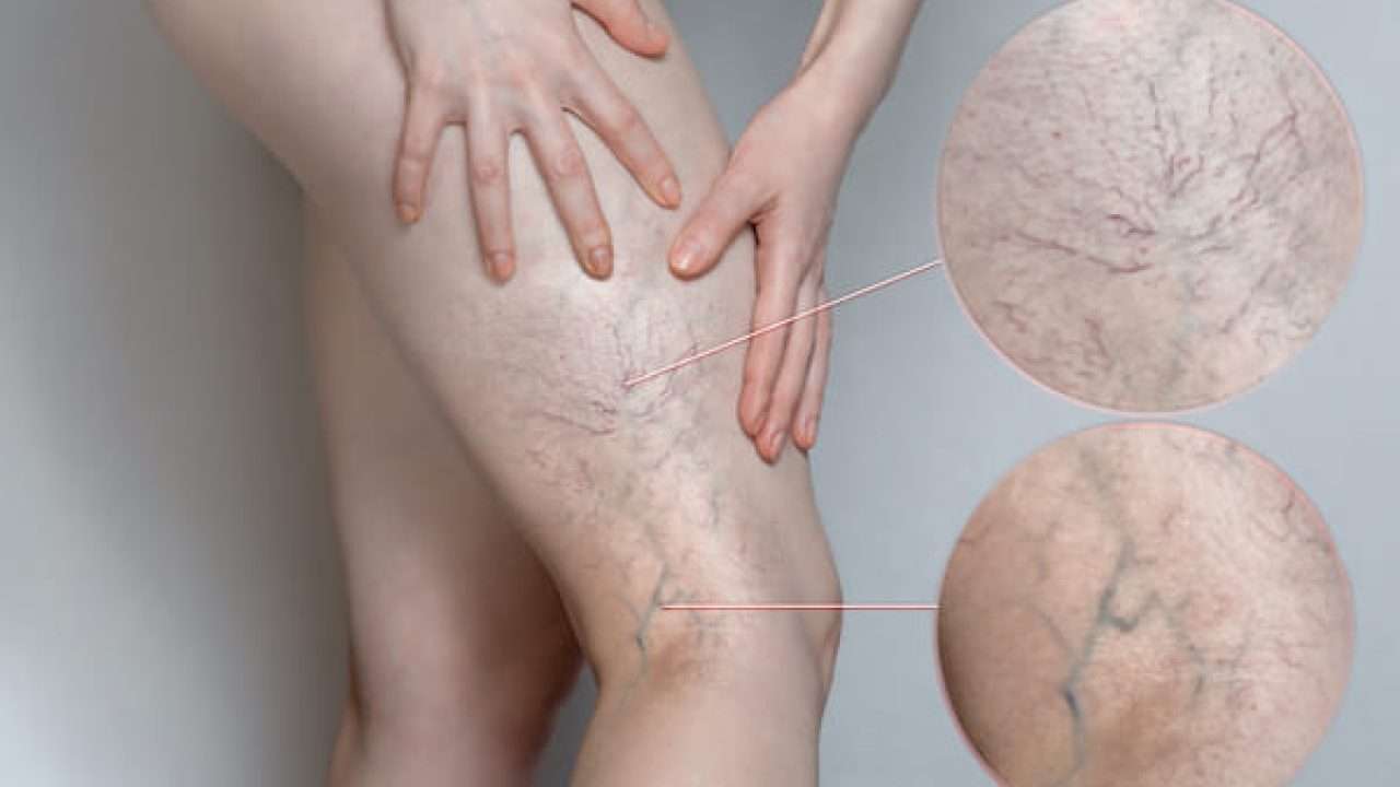 Best Ayurvedic Treatment for Varicose Veins: Causes, Symptoms, Remedies & Medicine