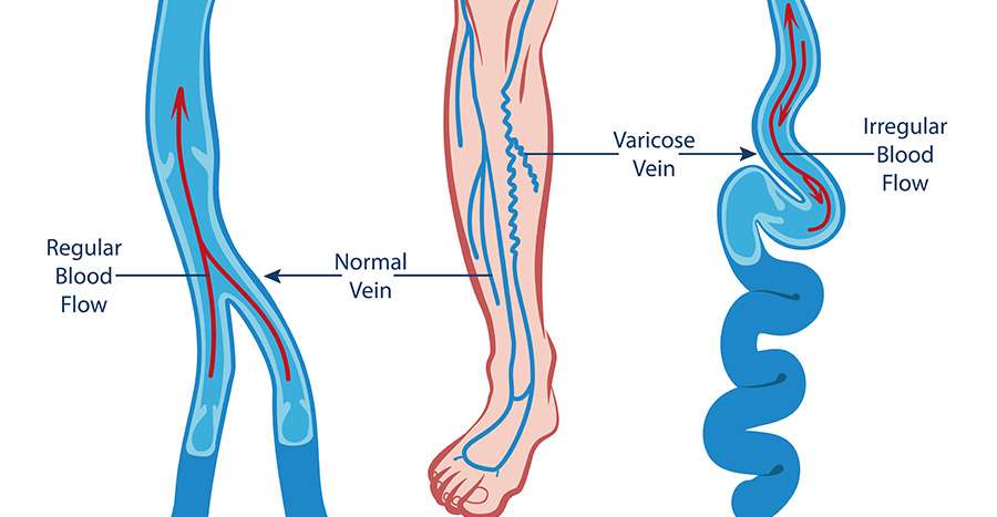 Varicose Vein Treatment in Mountain View & San Jose, CA