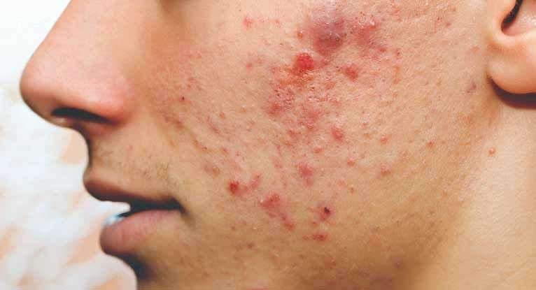 Best 10 Remedies for Pimples: Natural Solutions