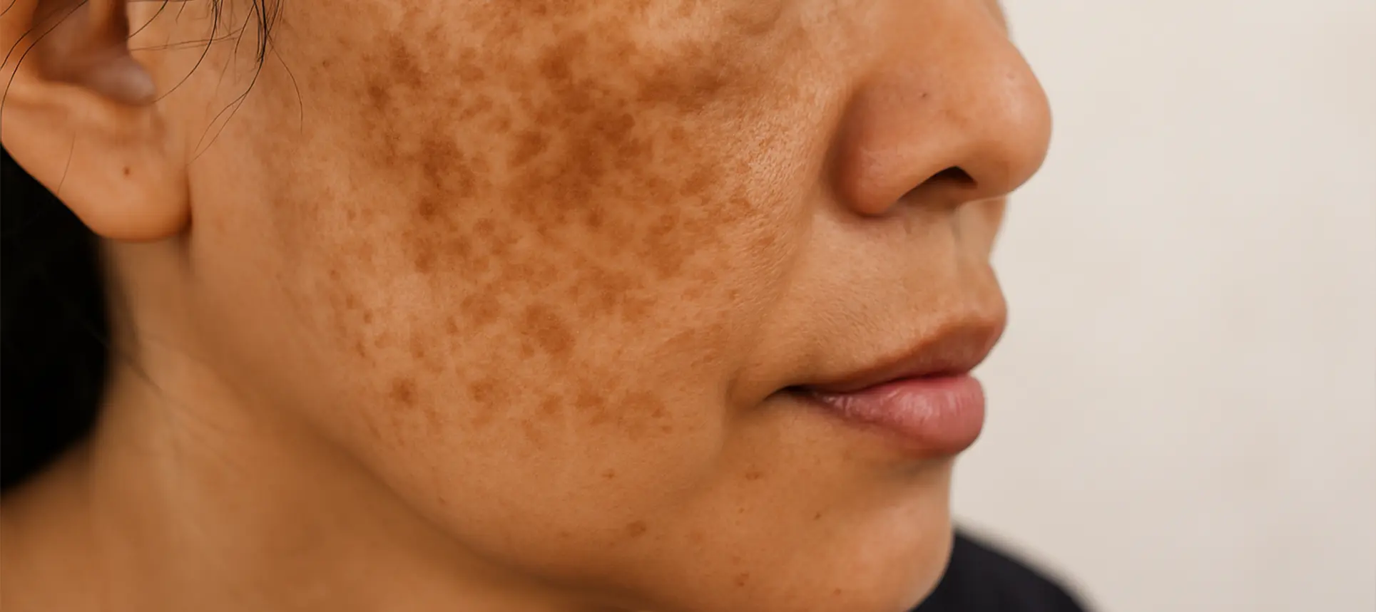 Pigmentation Problem: Causes, Signs, and Ayurvedic Care