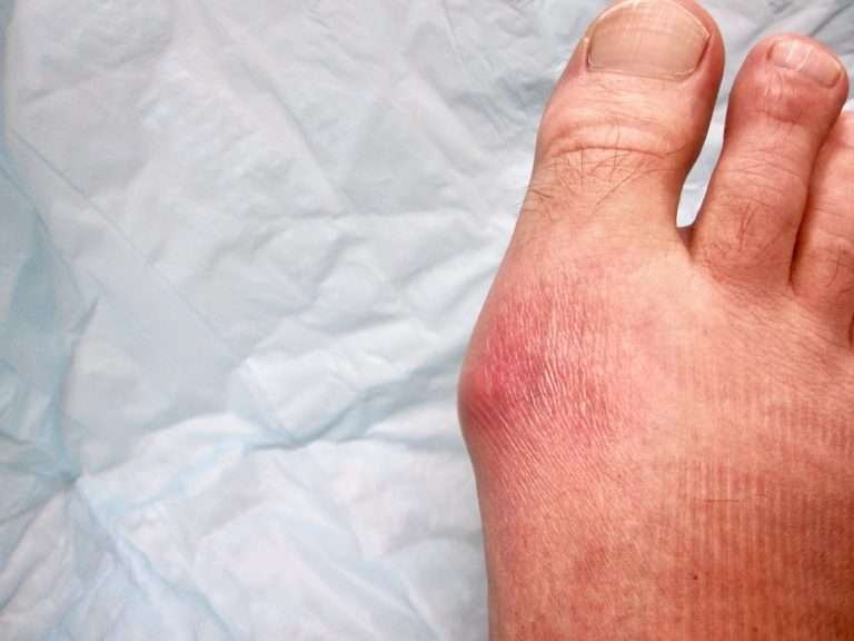 Uric Acid Problem: Causes, Symptoms & Ayurvedic Solutions