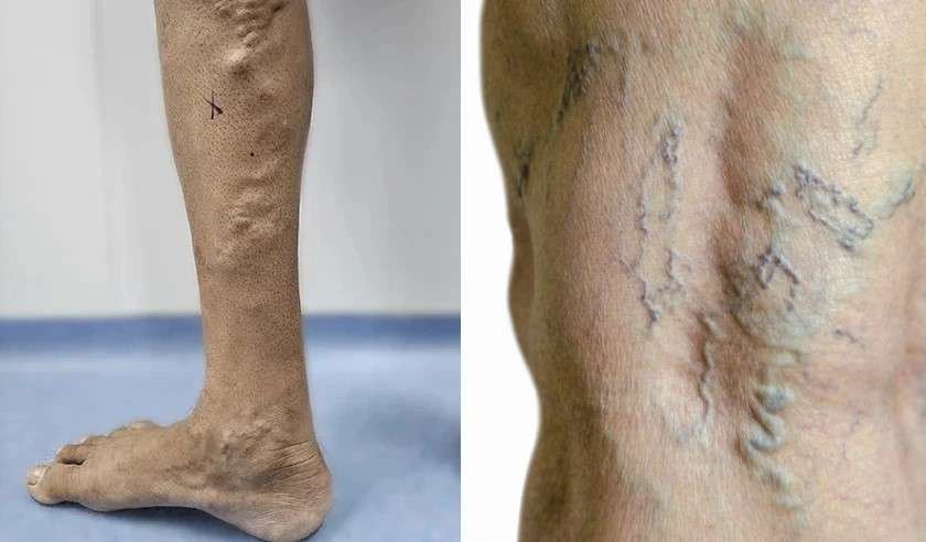 Varicose Veins: Causes, Symptoms, and Ayurvedic Solutions