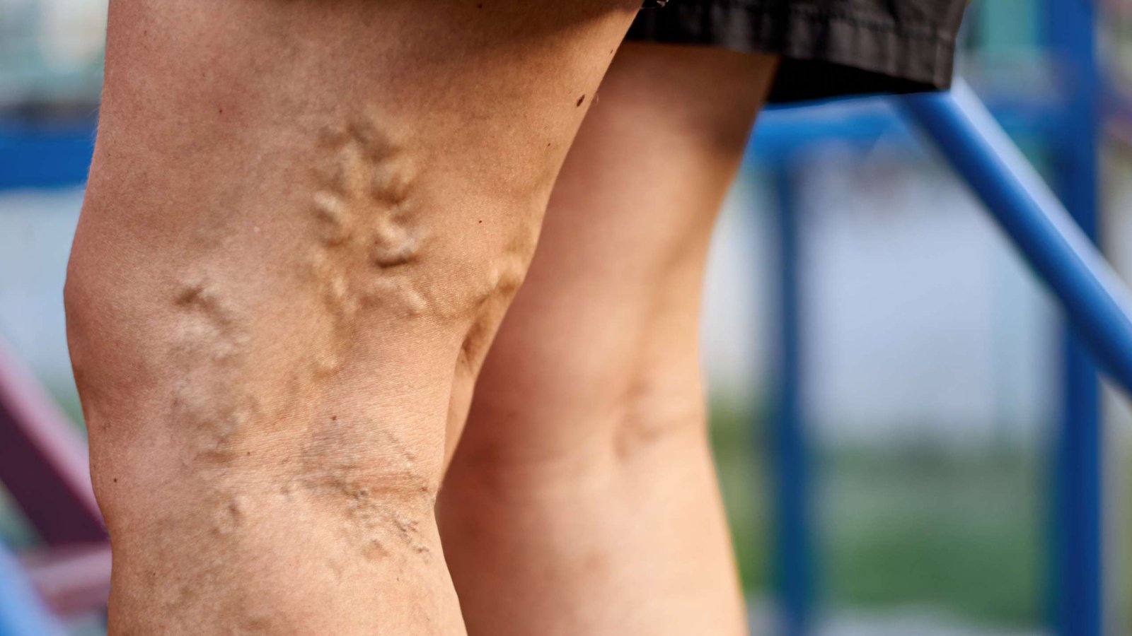 10 Signs of Varicose Veins You Should Not Ignore