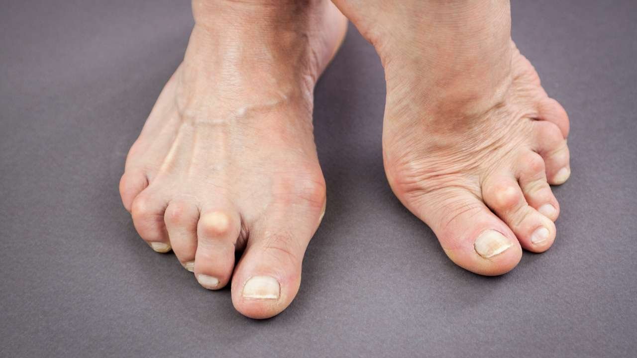 10 Signs of Arthritis You Should Not Ignore