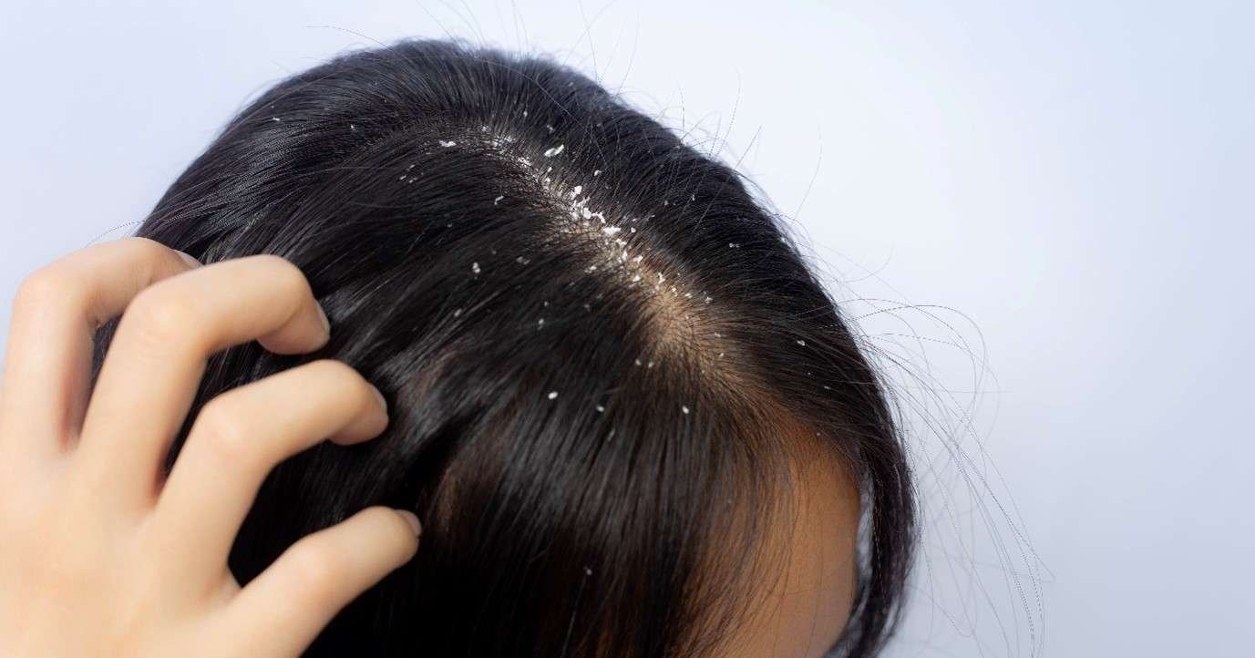Dandruff: An Ayurvedic Guide to Causes, Care & When to Consult
